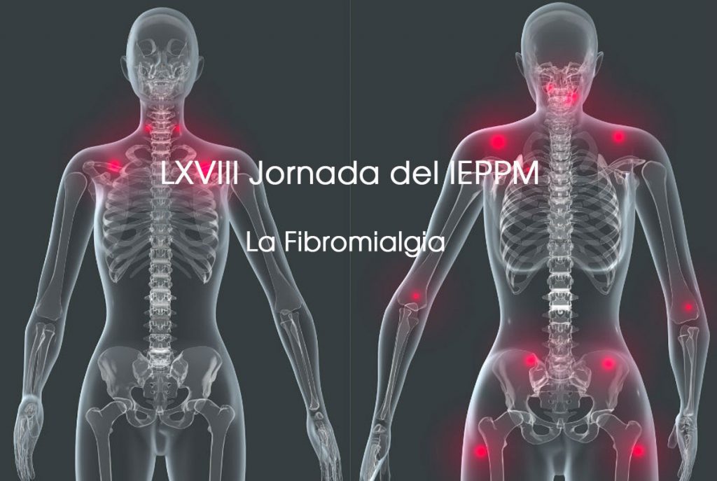 Fibromialgia