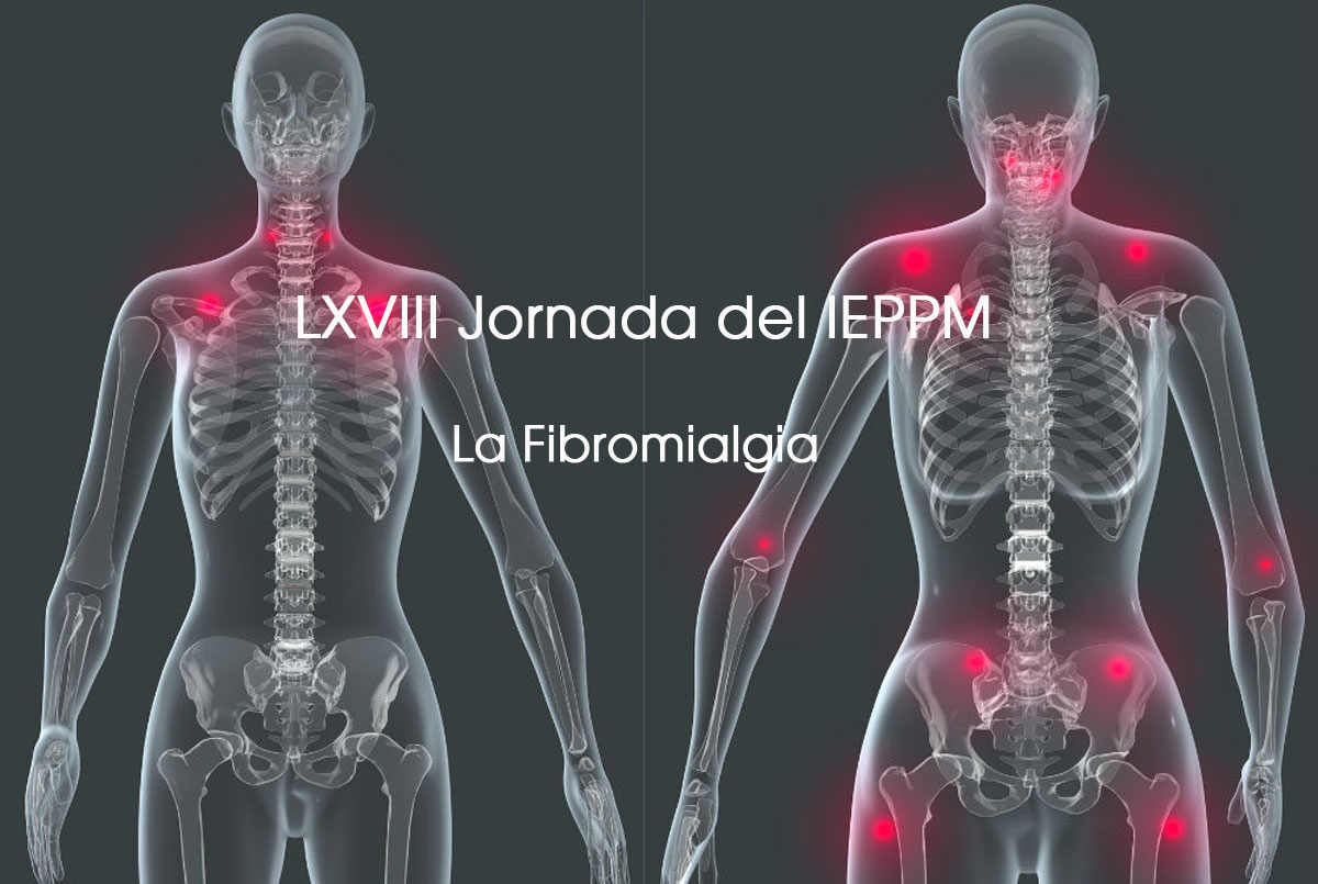 Fibromialgia